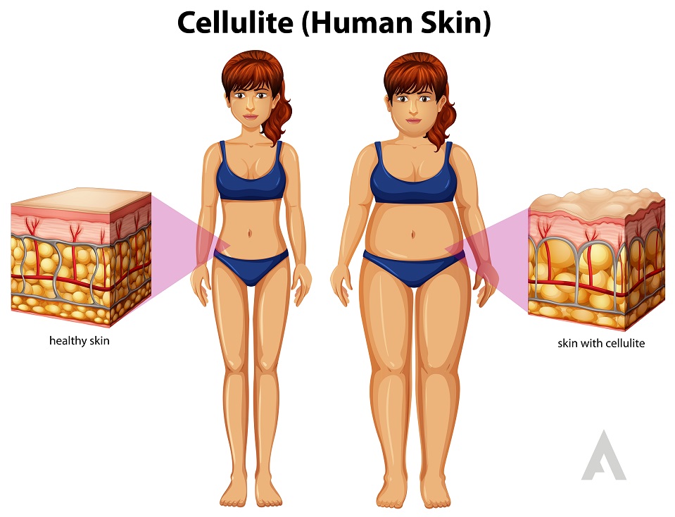Cellulite and Fats: Causes, Treatment, and Prevention
